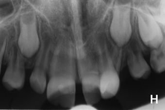 Διδυμία δοντιών-ΕΤ-αρχική πανοραμική λεπτομέρεια.JPG
