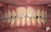 Διδυμία δοντιών-ΕΤ-τελική δοντιών.JPG