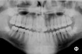 Διδυμία δοντιών-ΕΤ-τελική πανοραμική.JPG