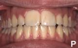 Διδυμία δοντιών-ΕΤ-τελική δοντιών.JPG