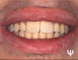 Διδυμία δοντιών-ΕΤ-τελική χαμόγελο.JPG
