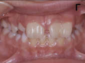 Διδυμία δοντιών-ΕΤ-αρχική δοντιών.JPG