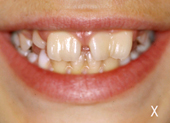 Διδυμία δοντιών-ΕΤ-αρχική χαμόγελο.JPG